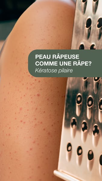Crème Anti Poils Incarnés — Kératose Pilaire