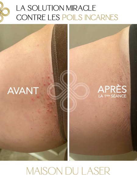 Crème Anti Poils Incarnés — Kératose Pilaire