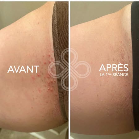 Crème Anti Poils Incarnés — Kératose Pilaire