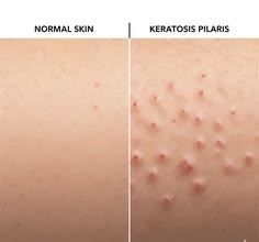 Crème Anti Poils Incarnés — Kératose Pilaire